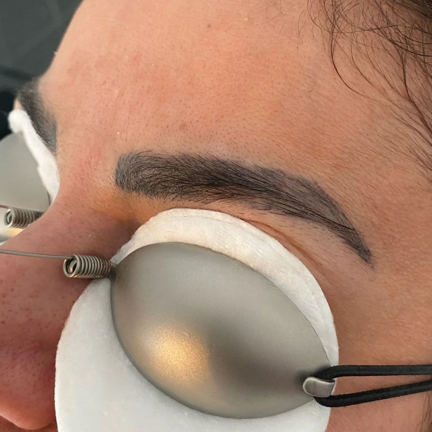 Borttagning av permanent makeup i ögonbrynen med ögonskydd på plats