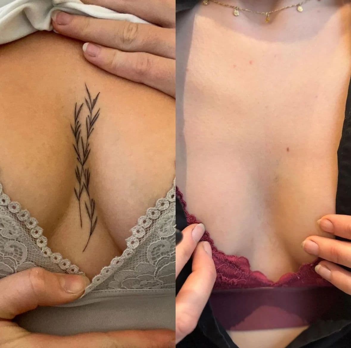 Före och efter: tatuering av ett blad mellan brösten, borttagen