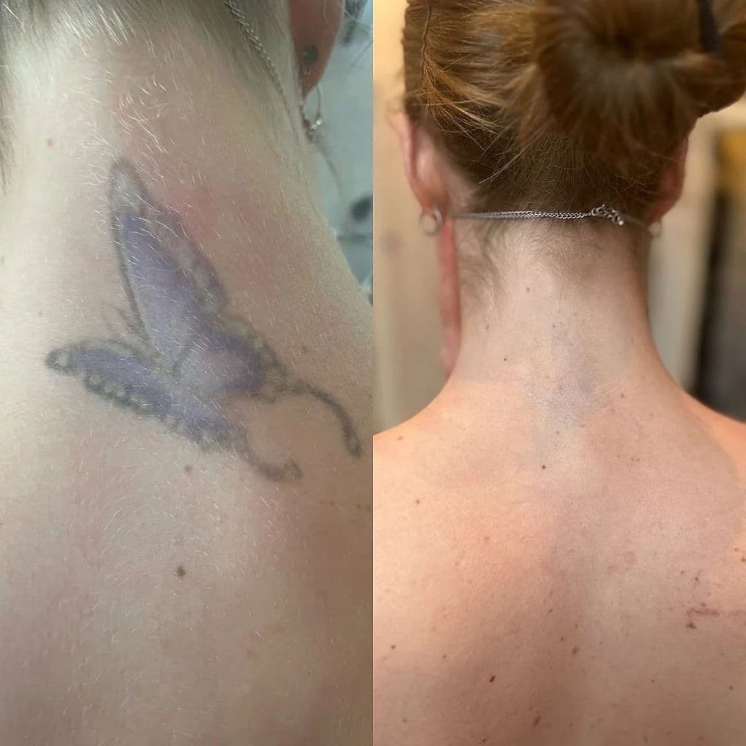 Före och efter: fjäril i nacken, borttagen