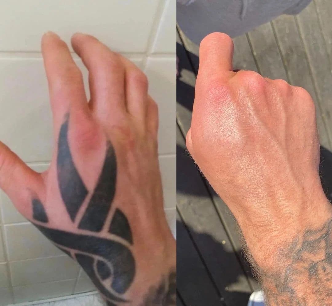 Före och efter: svart tatuering på handen, borttagen