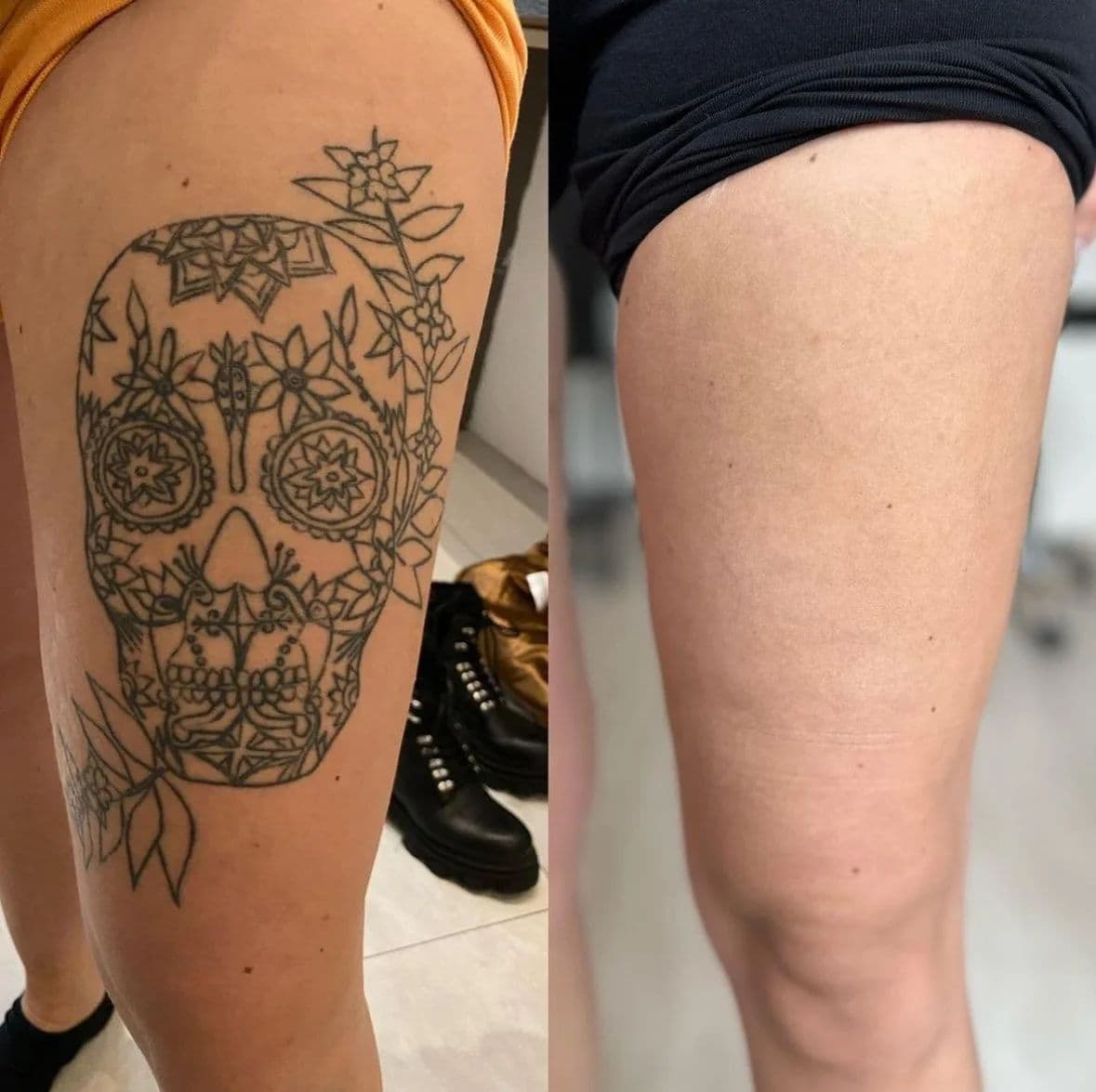 Före och efter: dödskallemotiv på låret, borttaget