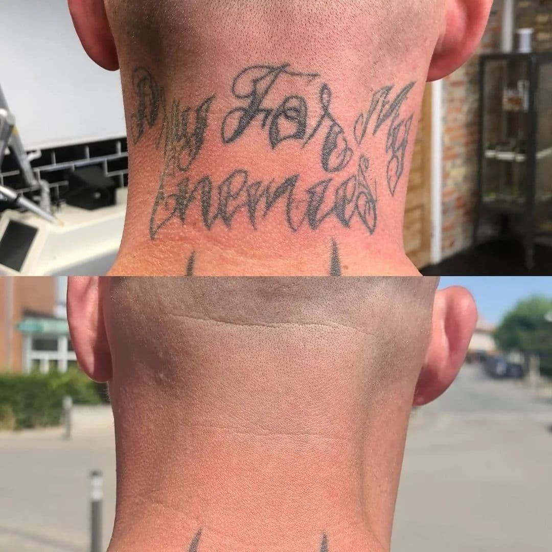 Före och efter: text-tatuering i nacken, borttagen
