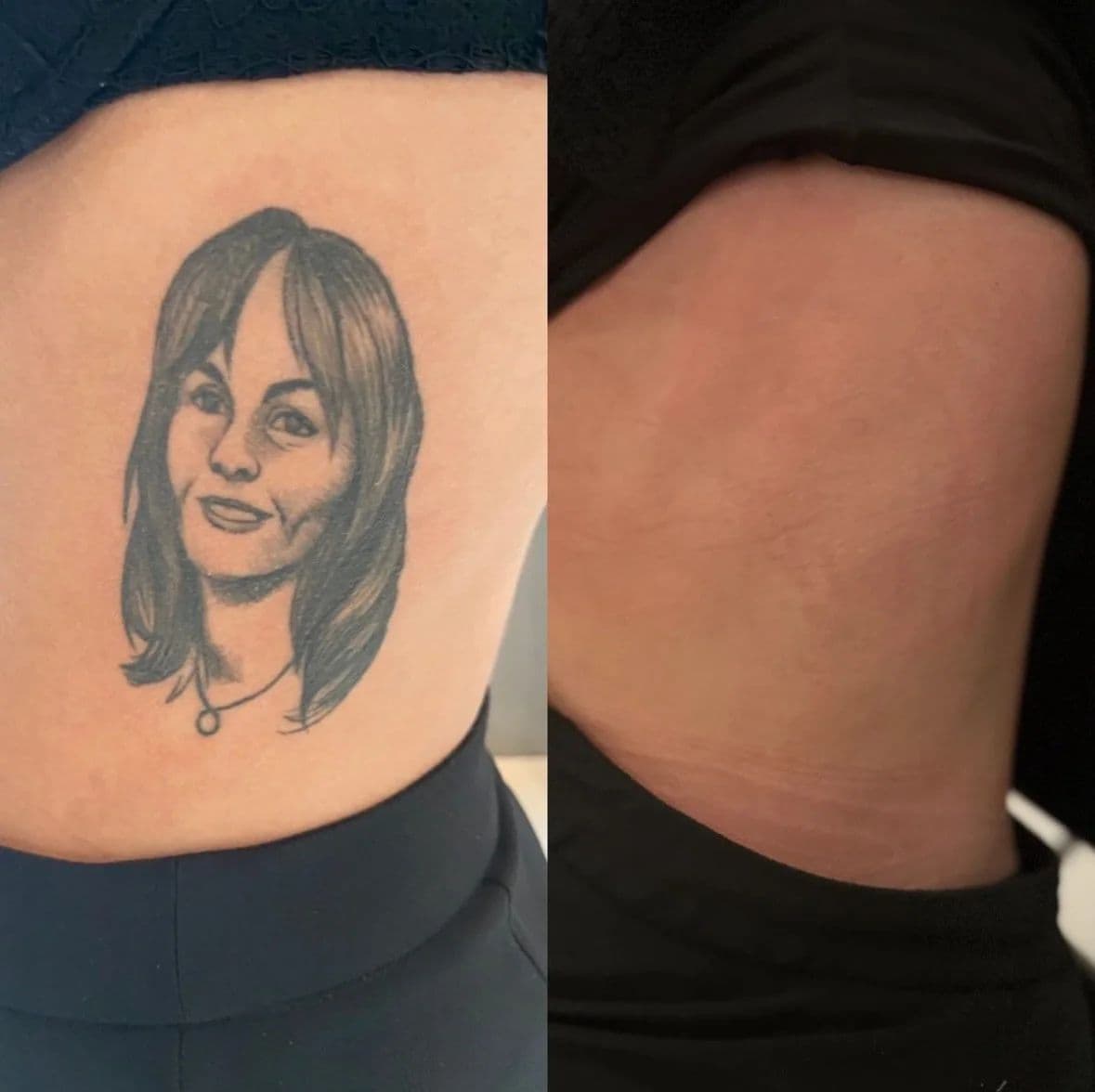 Före och efter: porträtt-tatuering på sidan av låret, borttagen