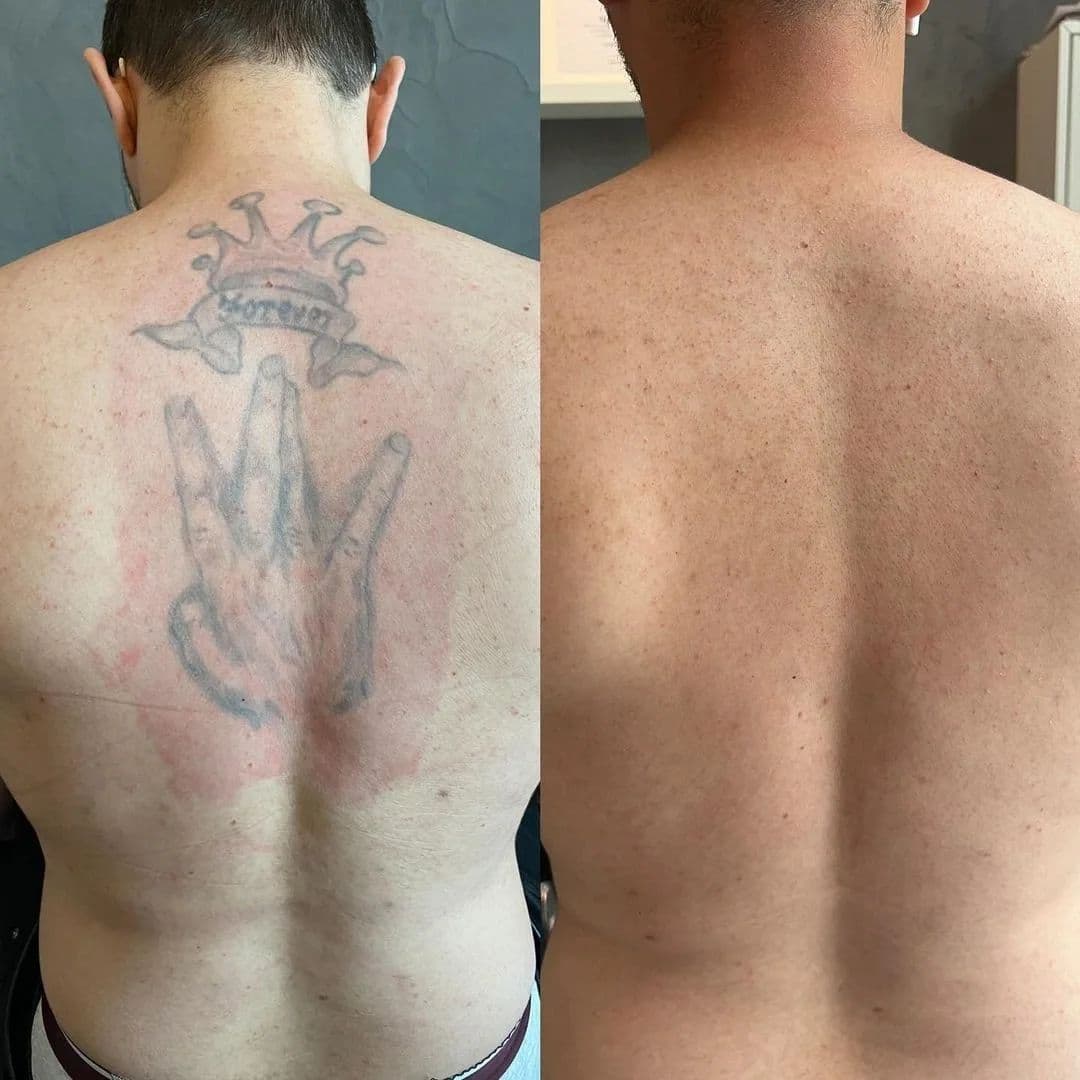 Före och efter: tatuering mitt på ryggen, borttagen