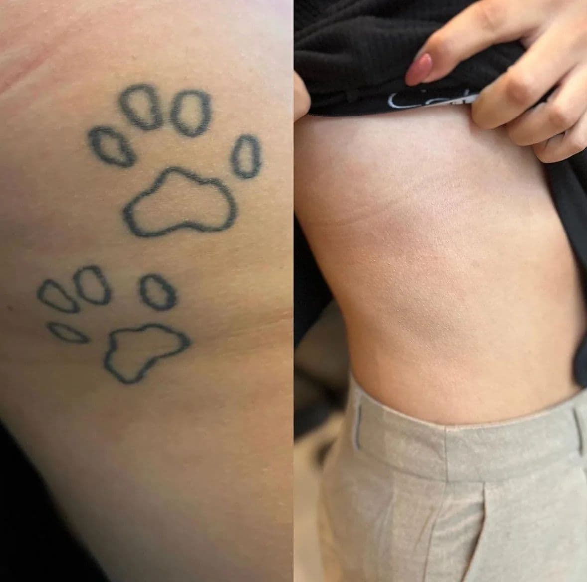 Före och efter: tassavtryck på höften, borttagna