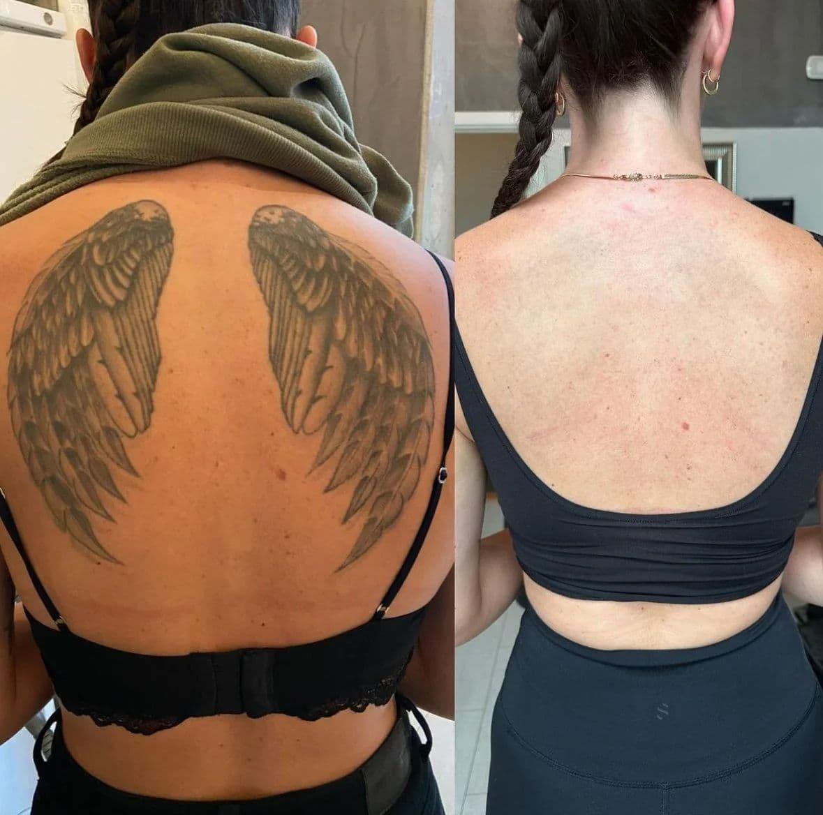 Före och efter: stor vingtatuering på ryggen borttagen hos NUDE Stockholm